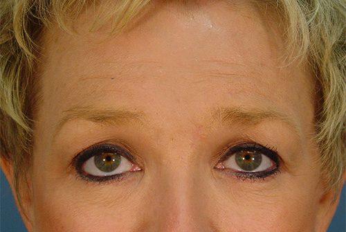 Case--2949 | After Lower Eyelid Surgery 