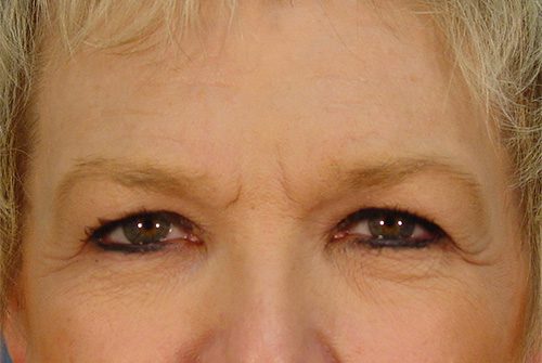 Case--2949 | Before Lower Eyelid Surgery 