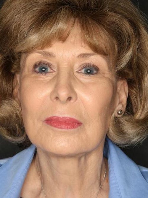 Case--6520 | After Facelift 