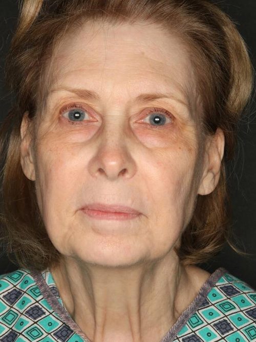 Case--6520 | Before Facelift 