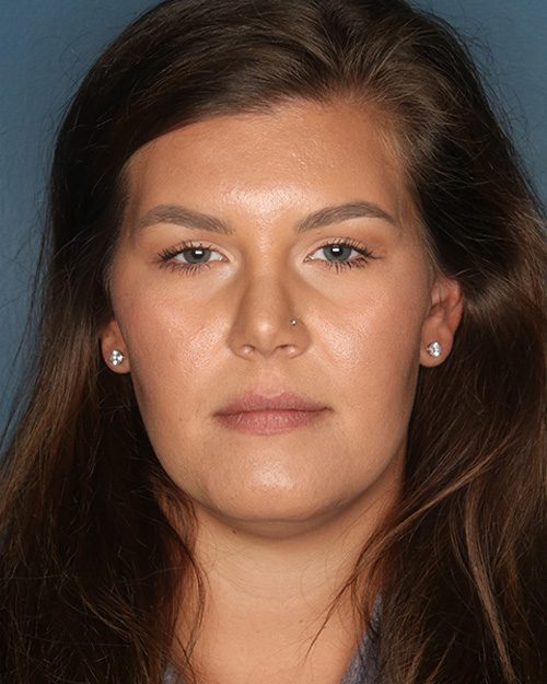 Case--5666 | After Rhinoplasty 