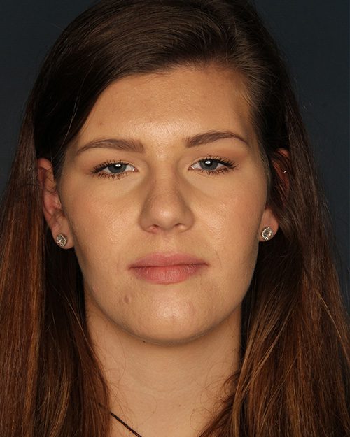 Case--5666 | Before Rhinoplasty 