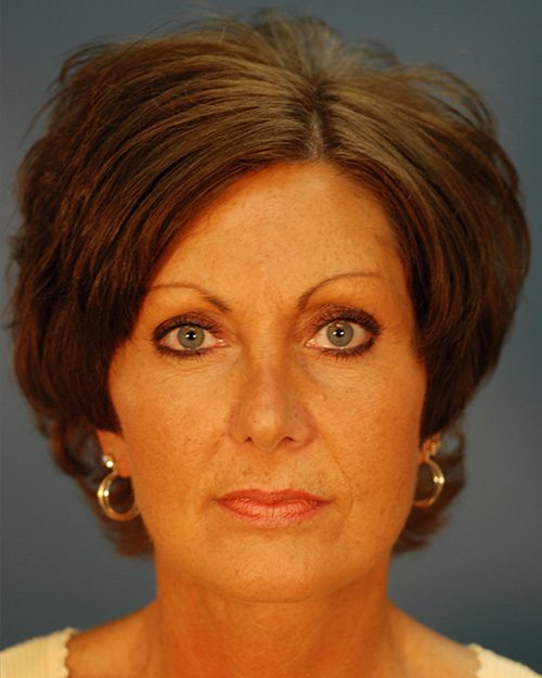 Case--5902 | After Rhinoplasty 