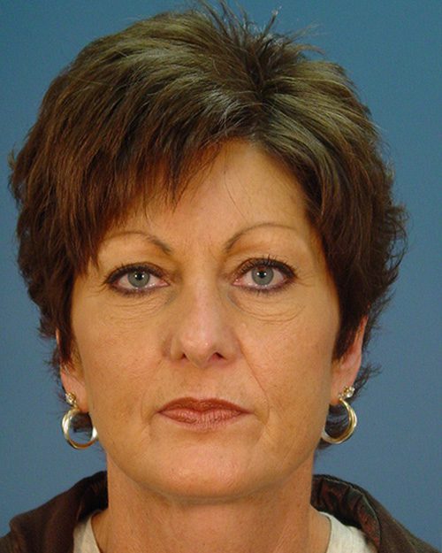 Case--5902 | Before Rhinoplasty 