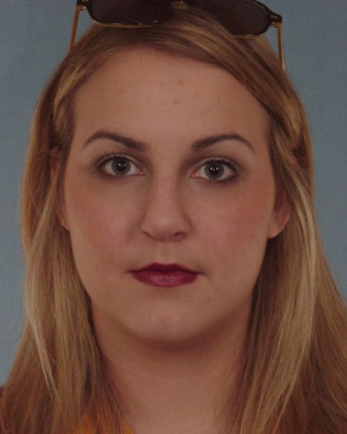 Case--4049 | Before Rhinoplasty 