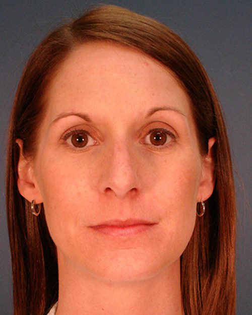 Case--9653 | Before Rhinoplasty 