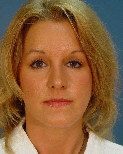 Case--4019 | After Rhinoplasty 