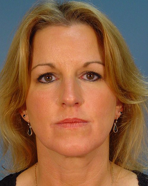 Case--4019 | Before Rhinoplasty 