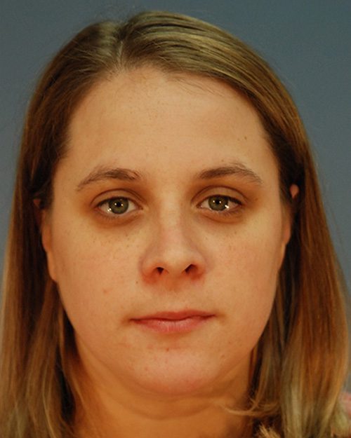 Case--2994 | After Rhinoplasty 