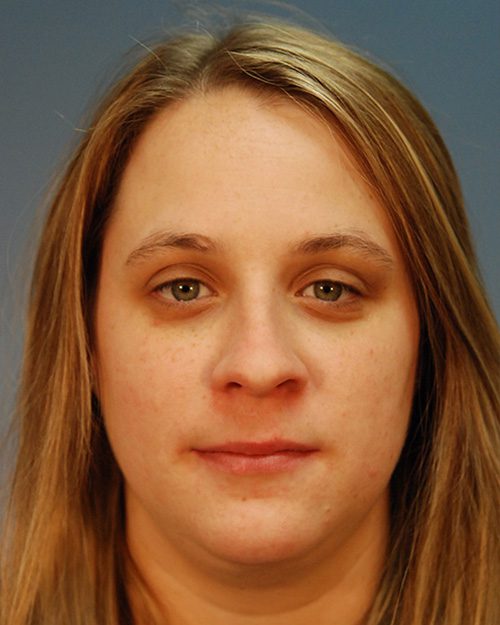 Case--2994 | Before Rhinoplasty 