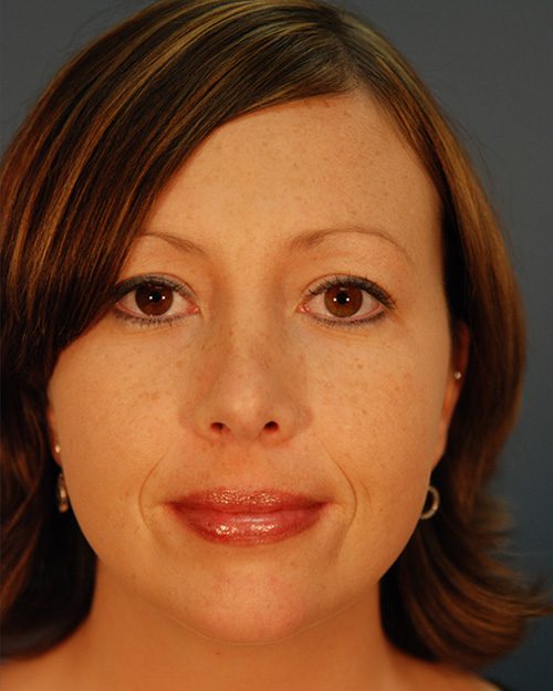 Case--7160 | After Rhinoplasty 