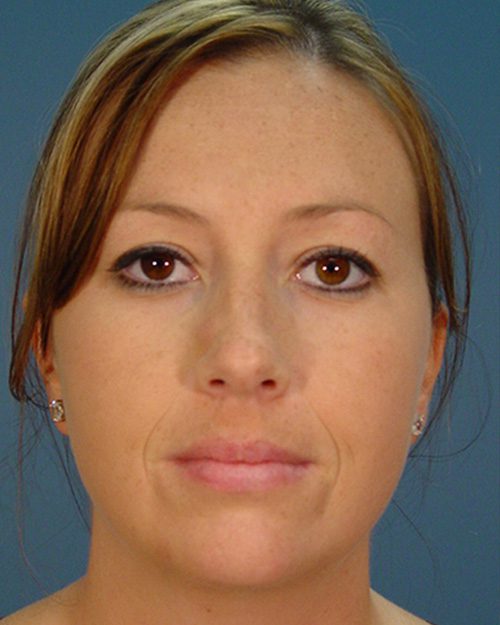 Case--7160 | Before Rhinoplasty 