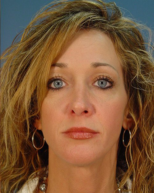 Case--1455 | After Rhinoplasty 