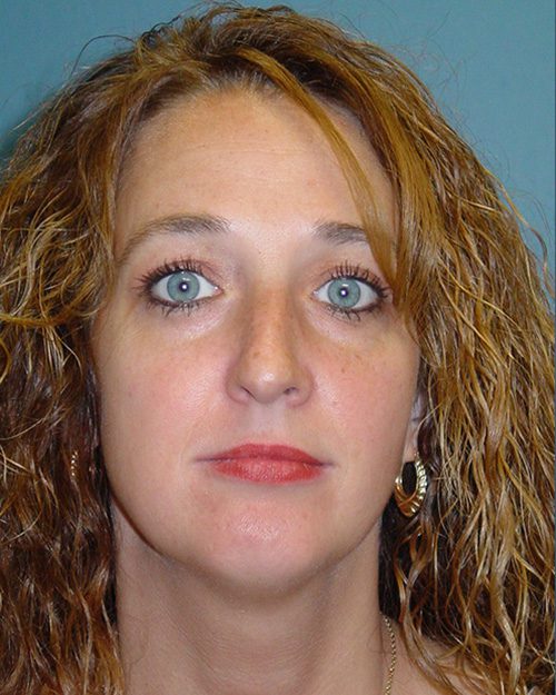 Case--1455 | Before Rhinoplasty 