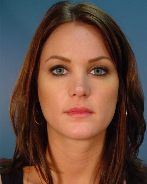 Case--1233 | After Rhinoplasty 