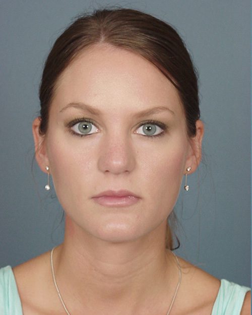 Case--1233 | Before Rhinoplasty 