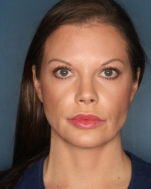 Case--9272 | After Rhinoplasty 