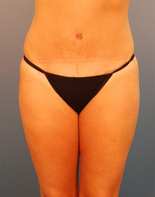 Case--1030 | After Abdominoplasty 