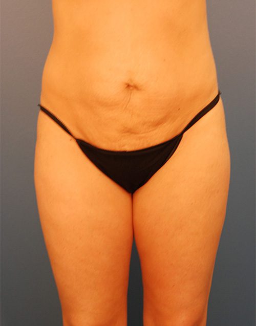 Case--1030 | Before Abdominoplasty 