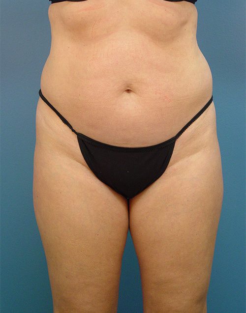 Case--4191 | Before Abdominoplasty 