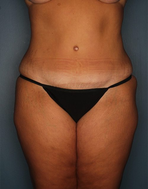 Case--3510 | After Abdominoplasty 