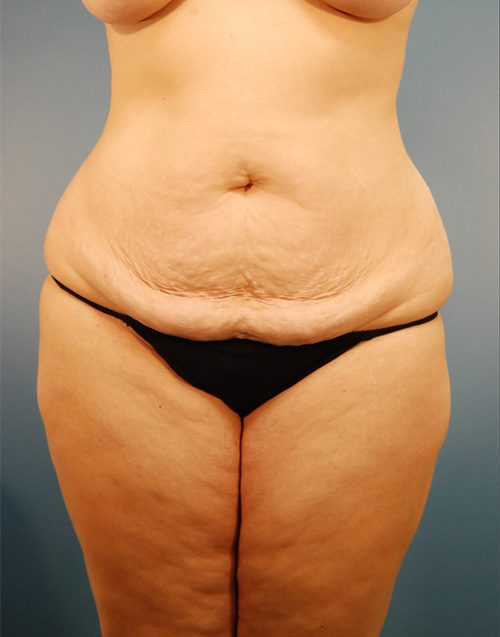 Case--3510 | Before Abdominoplasty 