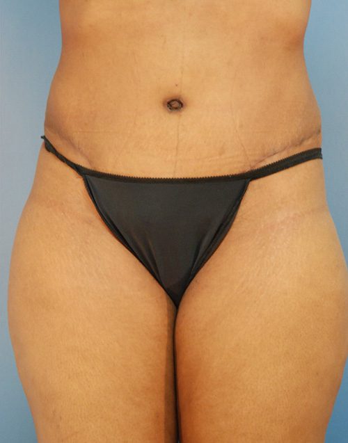 Abdominoplasty Patient After