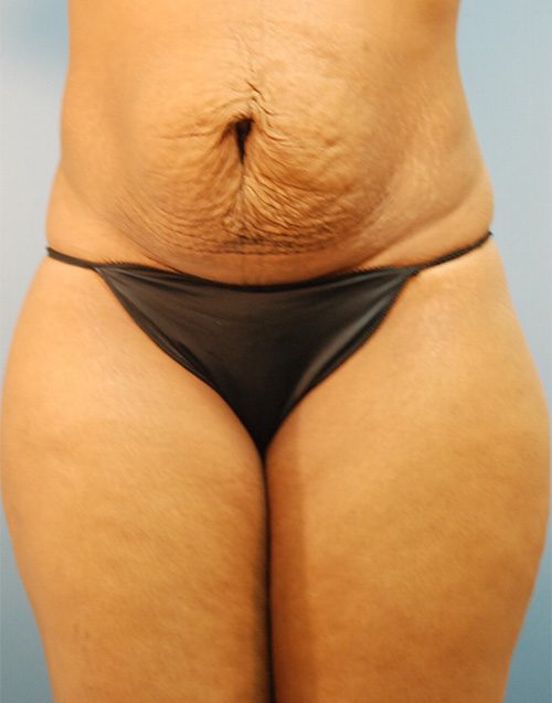 Abdominoplasty Patient Before