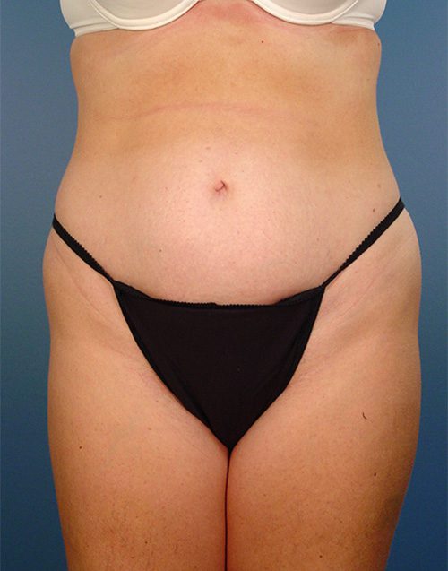 Case--9634 | Before Abdominoplasty 