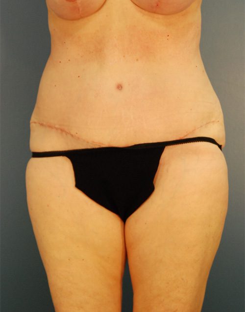 Case--4170 | After Abdominoplasty 