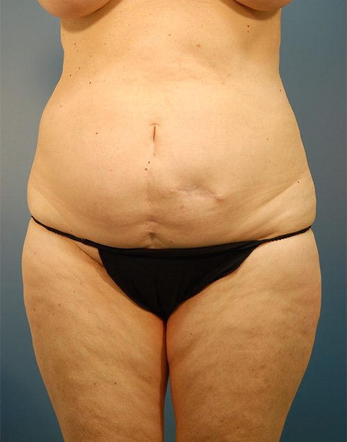Case--4170 | Before Abdominoplasty 