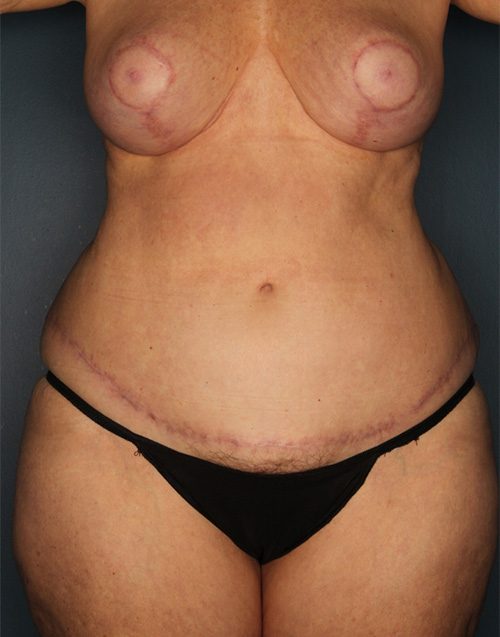Case--3883 | After Abdominoplasty 
