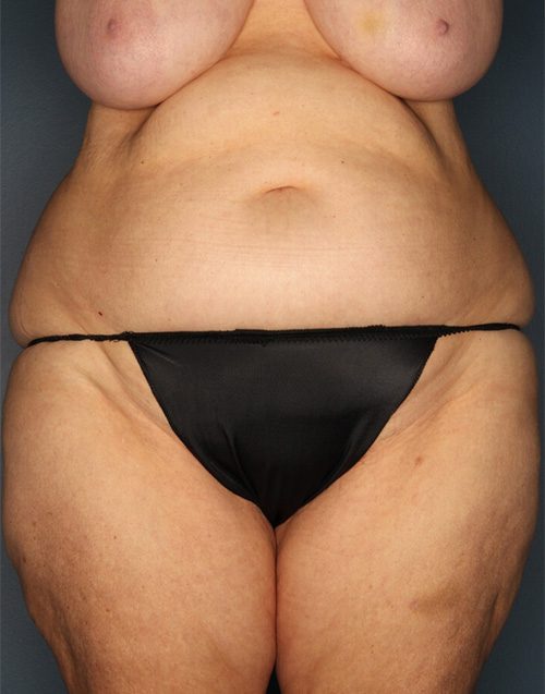 Case--3883 | Before Abdominoplasty 