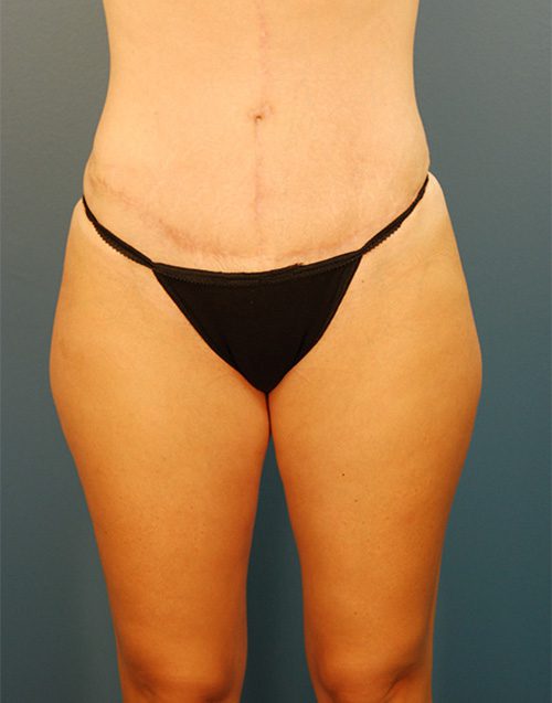 Case--7672 | After Abdominoplasty 