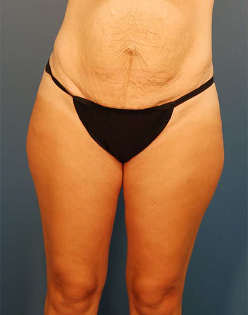 Case--7672 | Before Abdominoplasty 