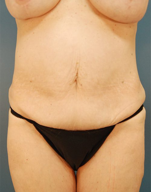 Case--2212 | Before Abdominoplasty 