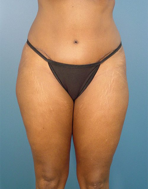 Case--1385 | After Abdominoplasty 