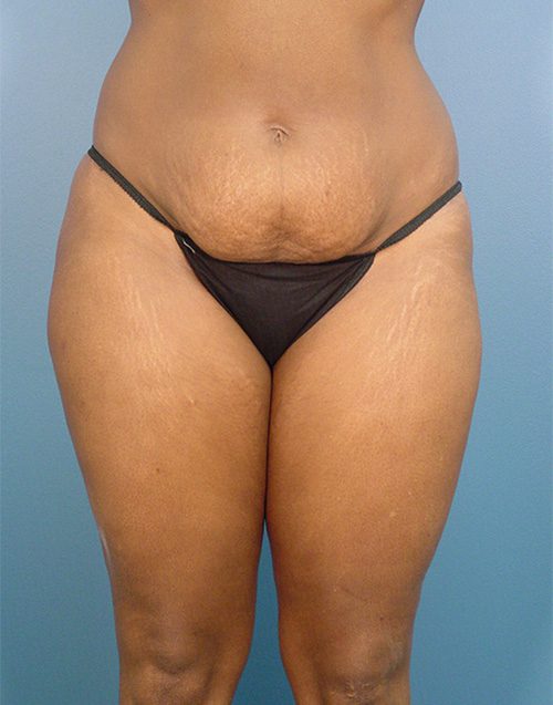 Case--1385 | Before Abdominoplasty 