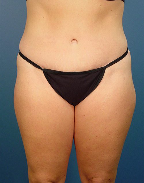 Case--2155 | After Abdominoplasty 