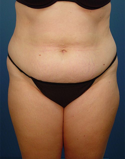 Case--2155 | Before Abdominoplasty 