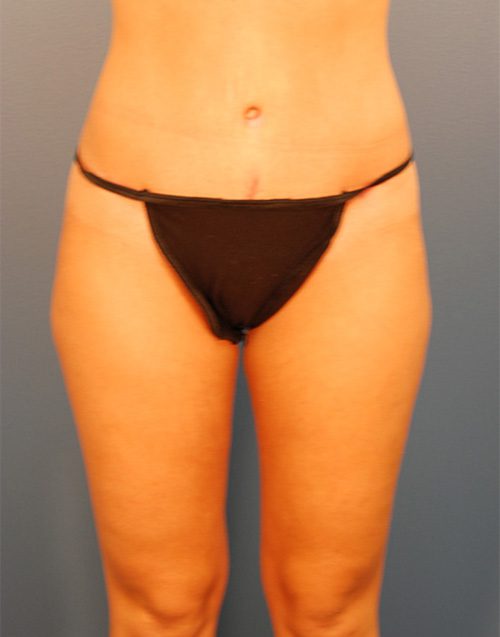 Case--1699 | After Abdominoplasty 
