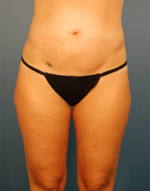 Case--1699 | Before Abdominoplasty 