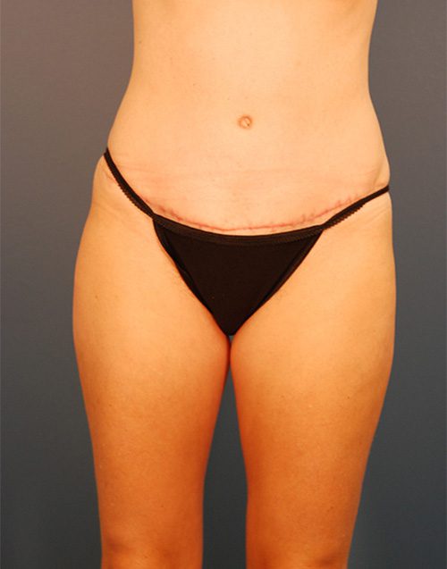 Case--4223 | After Abdominoplasty 