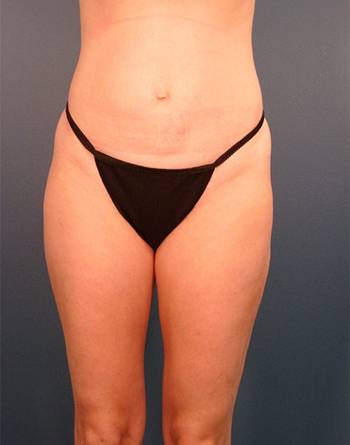 Case--4223 | Before Abdominoplasty 