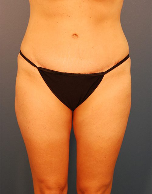 Case--1903 | After Abdominoplasty 