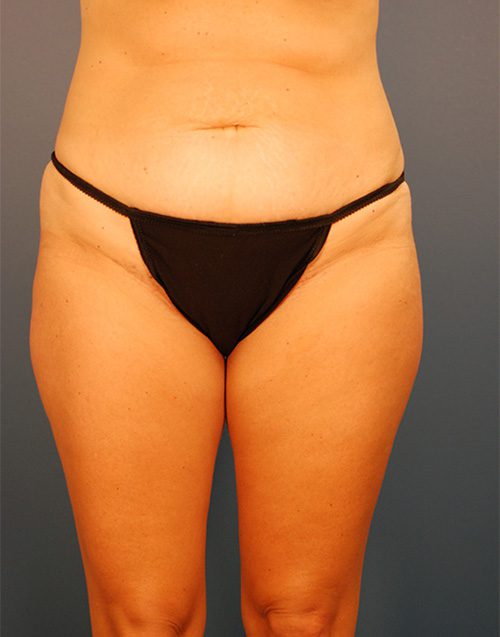 Case--1903 | Before Abdominoplasty 