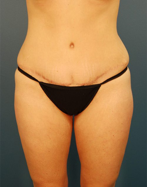 Case--583 | After Abdominoplasty 