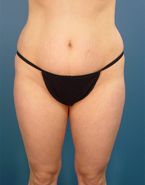 Case--583 | Before Abdominoplasty 