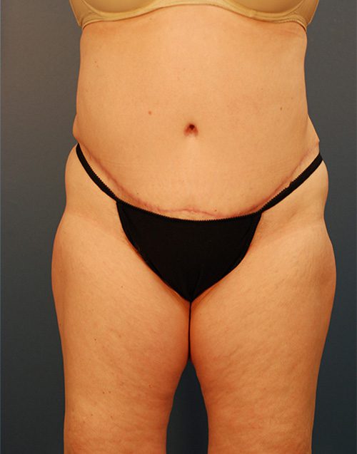 Case--3757 | After Abdominoplasty 