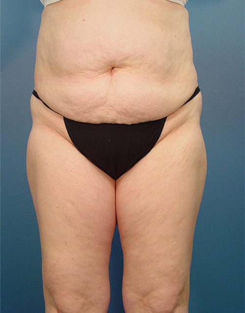 Case--3757 | Before Abdominoplasty 